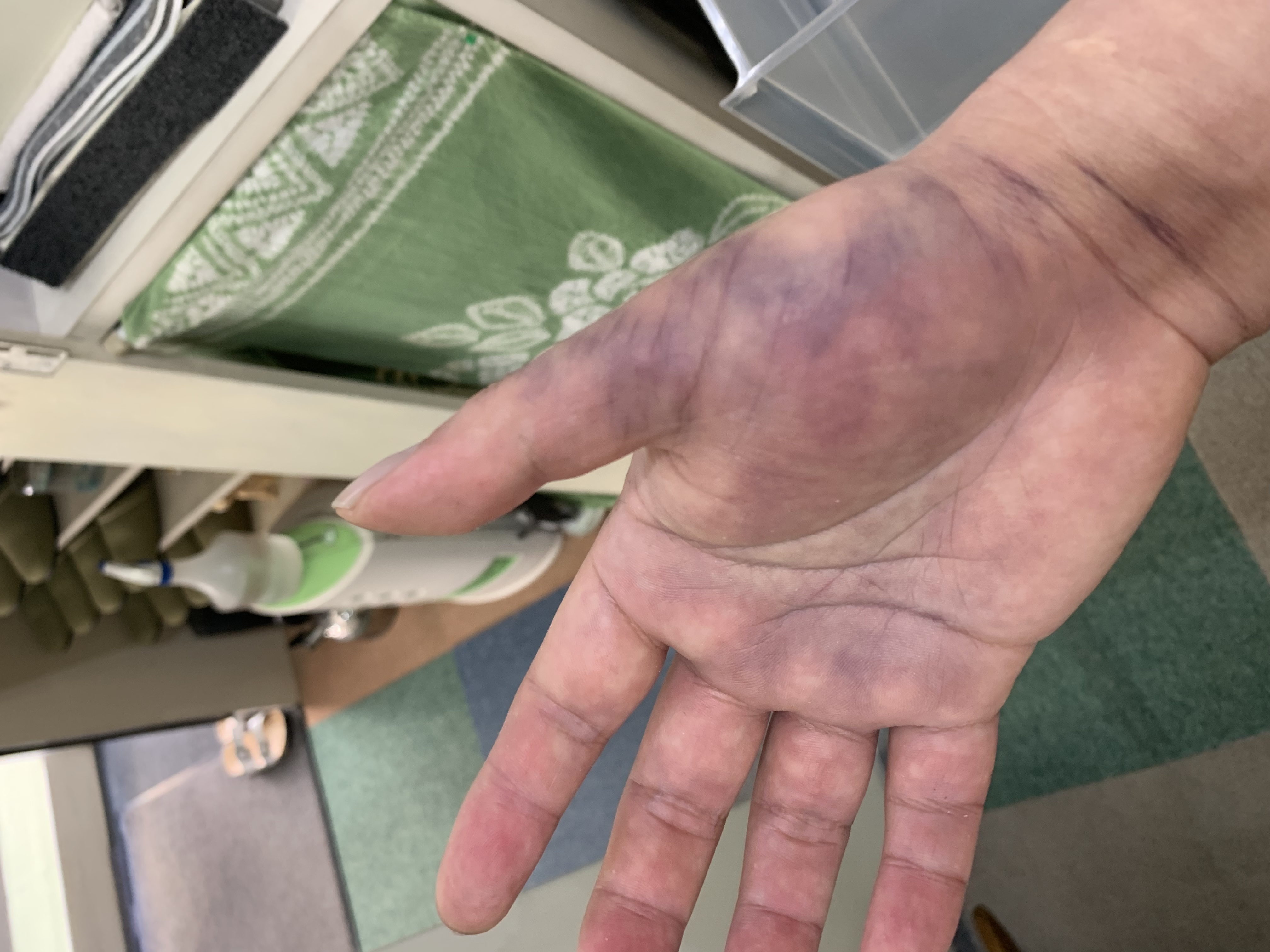 手の怪我について ヴェ太郎ブログ